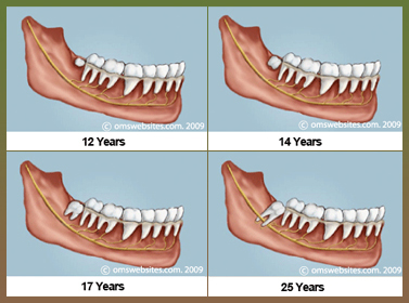 wisdom teeth coming in horizontally