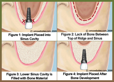 Sinus Lift Lake Country